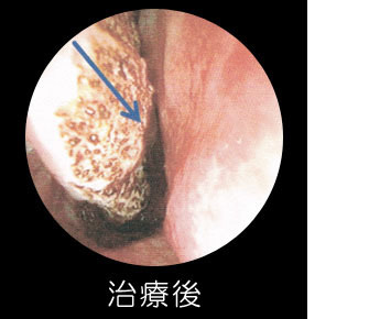 耳鼻咽喉科　はるクリニック レーザー治療