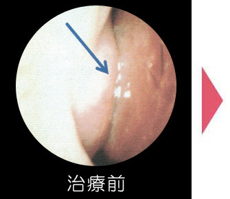 耳鼻咽喉科　はるクリニック レーザー治療